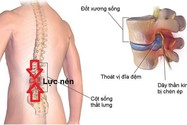 Điều trị thoát vị đĩa đệm bằng kỹ thuật hiệu chỉnh cơ xương khớp