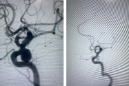 Phình mạch máu não mà ngỡ… rối loạn tiền đình