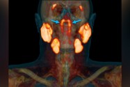 Các tuyến nước bọt hoàn toàn mới ở 2 bên vòm họng của bệnh nhân trải qua xạ trị ung thư.