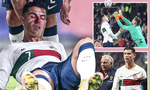 Khuôn mặt đẫm máu của Cristiano Ronaldo