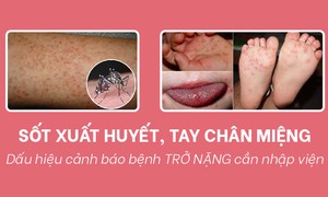 Dấu hiệu cảnh báo bệnh sốt xuất huyết và tay chân miệng trở nặng cần nhập viện 