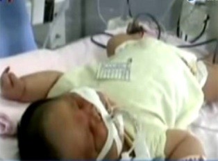 Bé sơ sinh khổng lồ 7,1 kg ảnh 1