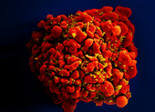 Em bé thứ ba trên thế giới được chữa khỏi HIV