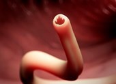 Ngồi trên bãi biển, bị giun chui từ mông lên phổi