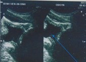 Tự lấy sỏi thận qua đường niệu bằng… cọng cỏ