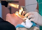 Có nên phẫu thuật chữa cận thị?