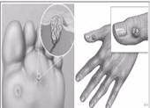 Mụn cóc và thuốc trị