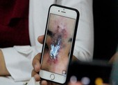 Nữ sinh viên suýt bay mất mũi vì tiêm filler