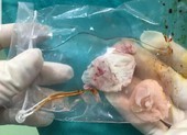 Mổ lấy ổ sán khổng lồ trong não người thích ăn tiết canh