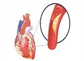Ai dễ mắc máu nhiễm mỡ?