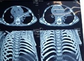 Bị que xiên thịt nướng đâm xuyên phổi, vỡ đốt sống