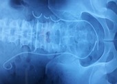 Ống JJ đứt làm 3 bị 'bỏ quên' trong niệu quản suốt 3 năm
