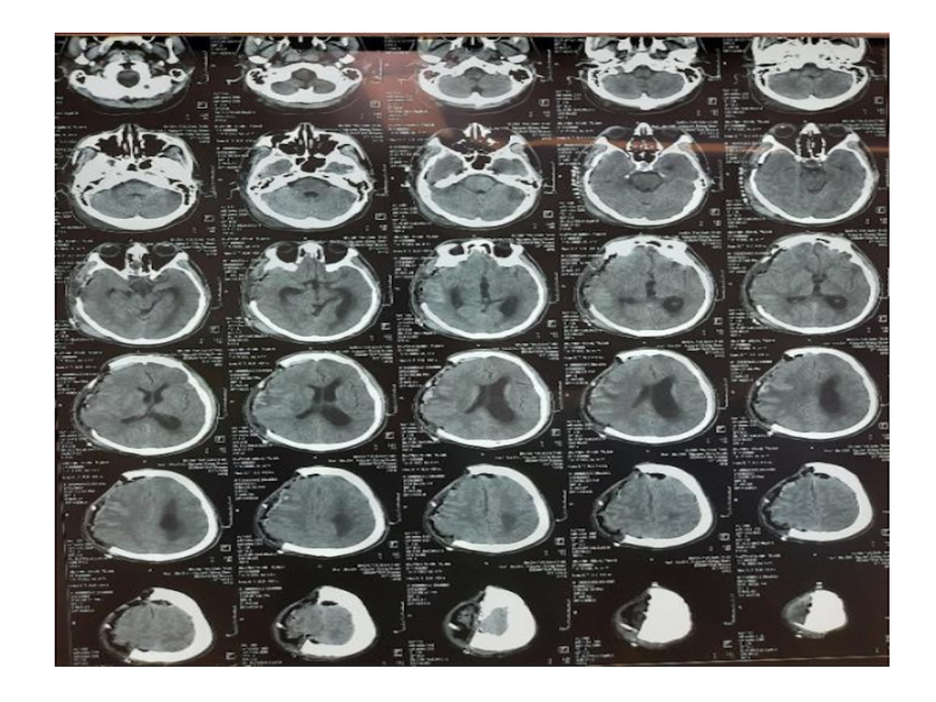 Hình ảnh não trước và sau phẫu thuật. Ảnh: BVCC 2