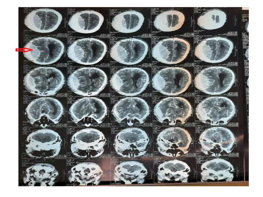 Hình ảnh não trước và sau phẫu thuật. Ảnh: BVCC 1