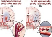 Tai biến mạch máu não: Cấp cứu thế nào để tránh tử vong?